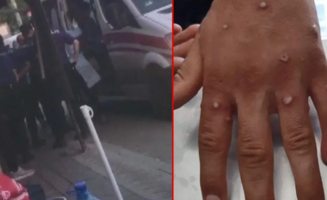 İstanbul'da maymun çiçeği alarmı: 3 Afgan özel ekiplerle alındı!