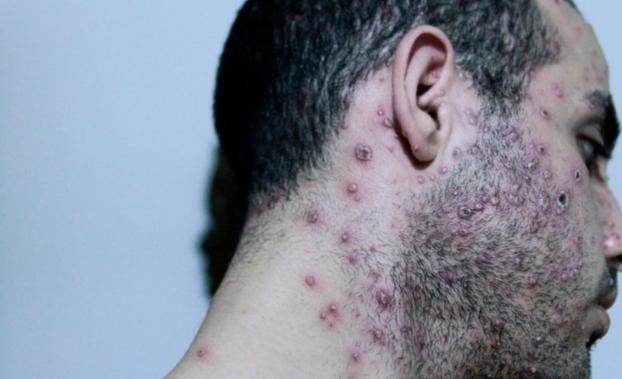 Türkiye'de ilk maymun çiçeği vakası görüldü: Belirtileri ortaya çıktı