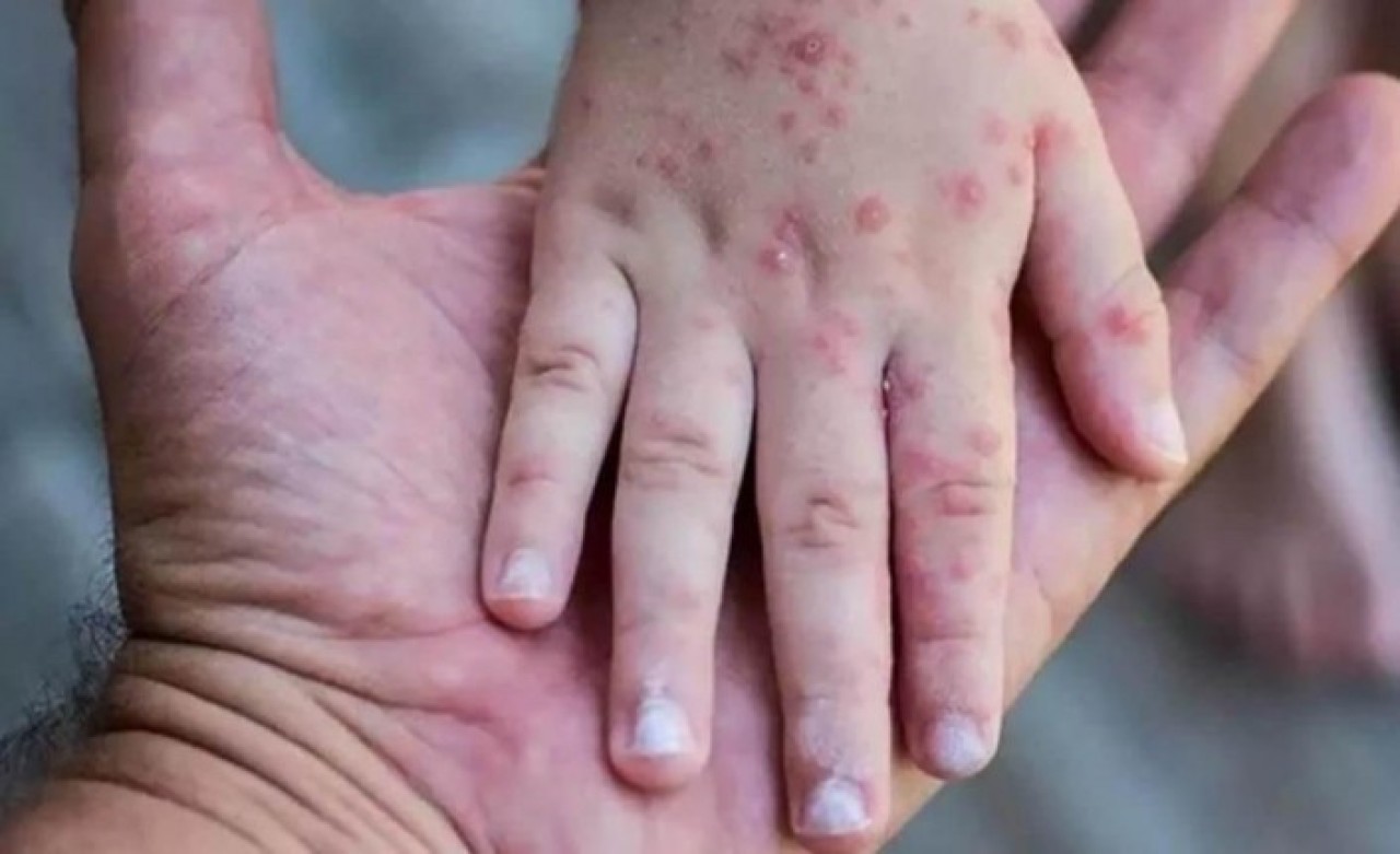 Bakan Koca'dan korkutan açıklama: Maymun çiçeği vakası yükseldi