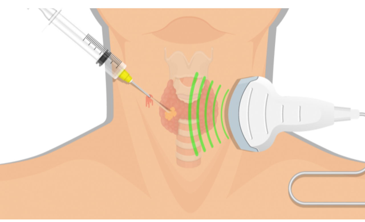 Hastalığa özgün ve en etkili tedavi biyopsiyle belirleniyor