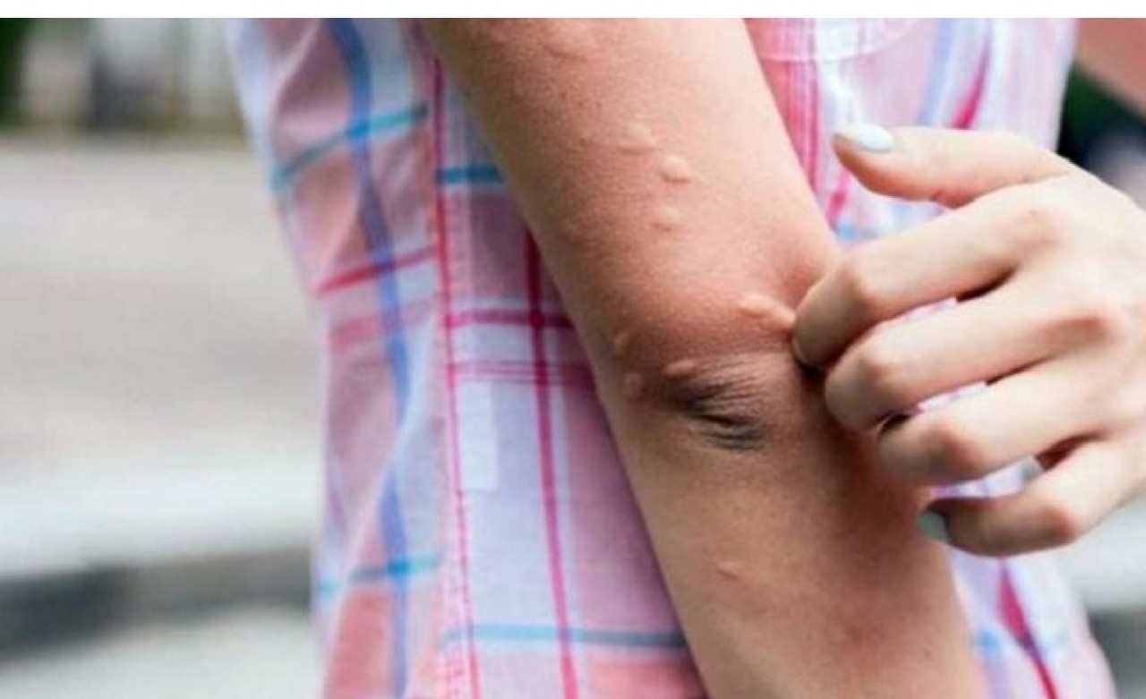 Vaka sayıları artınca yetkililer harekete geçti! Sağlık Bakanlığı'nın yayınladığı sivrisinekten korunma rehberi