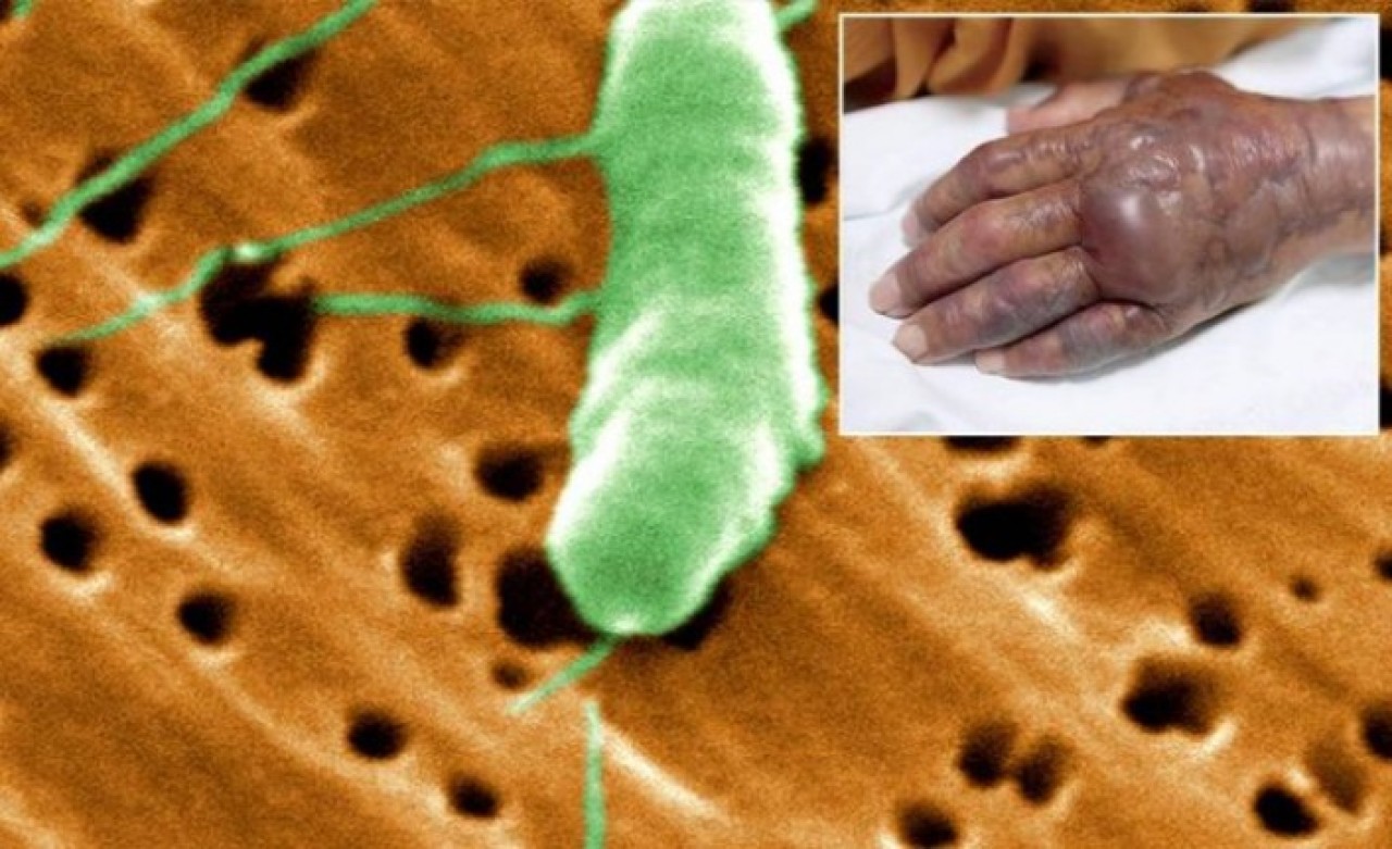 'Et yiyen bakteri' kabusu: Bu belirtilere dikkat!