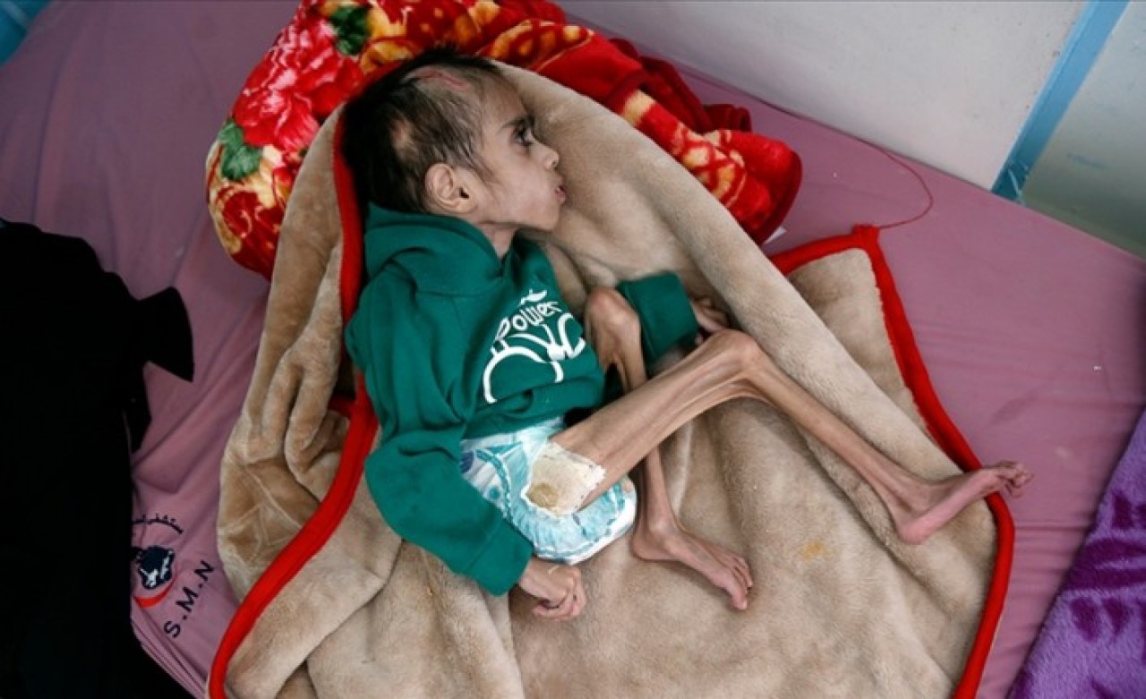 İnsan hakları savunucuları BM ve AB sınıfta kaldı! Yemen'de insani kriz!