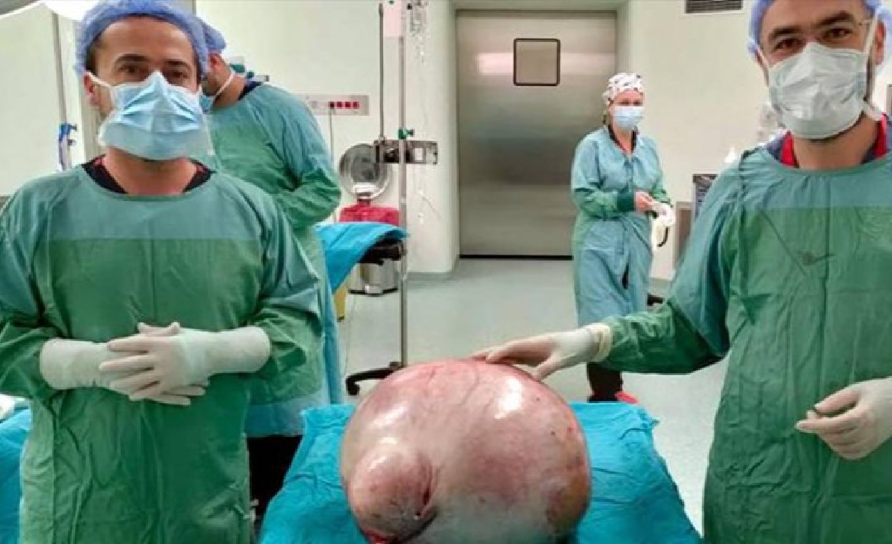 Kadın hastanın karnından 35 kilogramlık kitle çıkarıldı