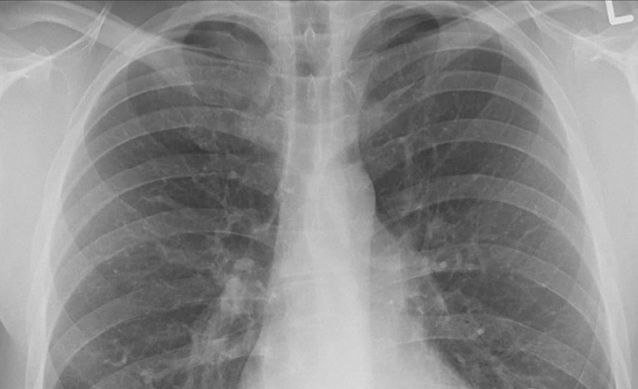 Pasif içicilerde "akciğer kanseri" riski yüzde 30 artıyor