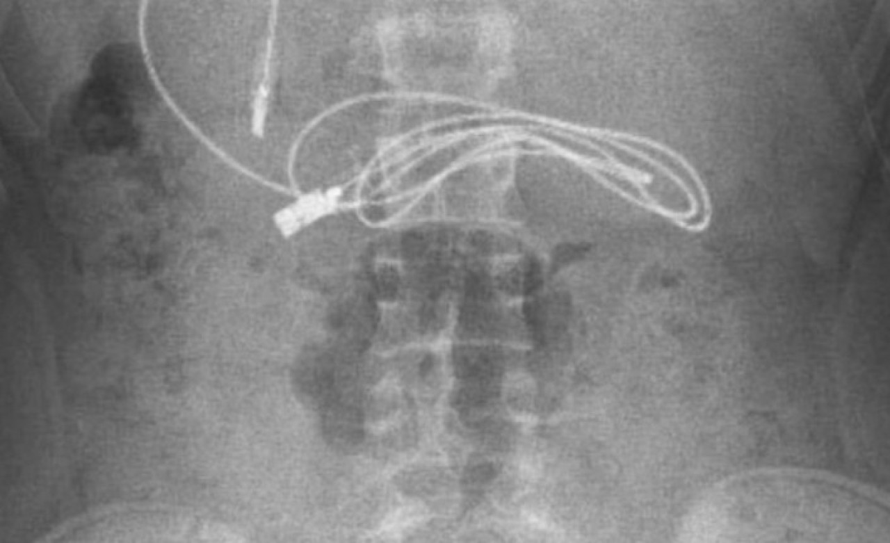 Anne ve babalar dikkat! 15 yaşındaki çocuğun midesinden çıkanlar şaşkına çevirdi