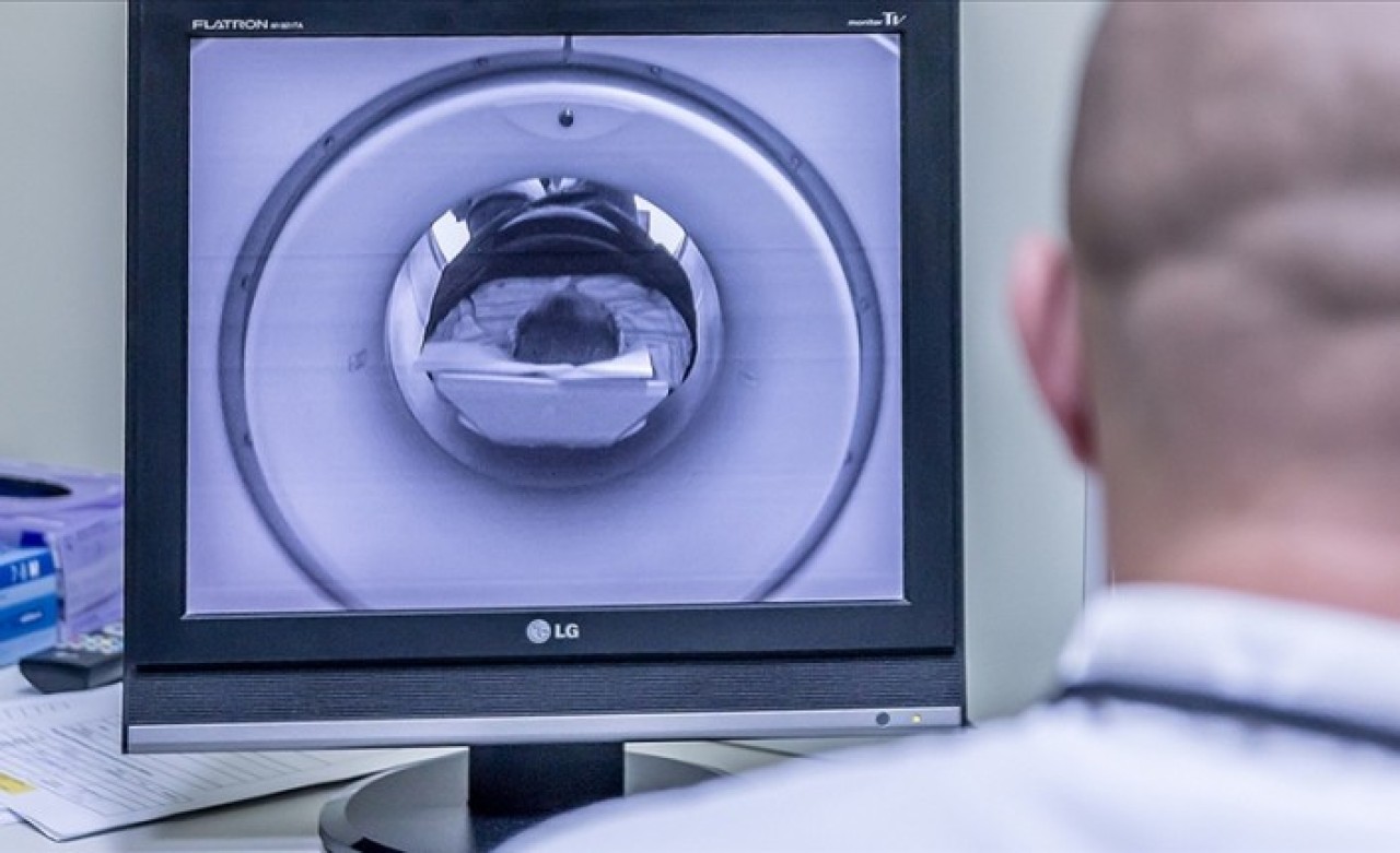 Bilim insanları yaygın görülen bir beyin tümörünün 3 alt türünü tespit etti