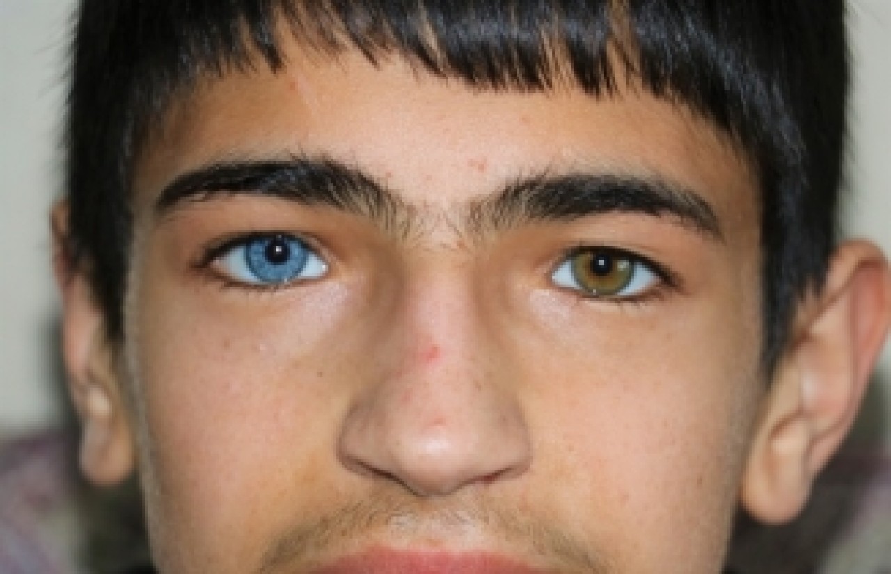 Bir Gözü Mavi Diğeri Kahverengi Olan Çocuklar Görenleri Şaşırtıyor