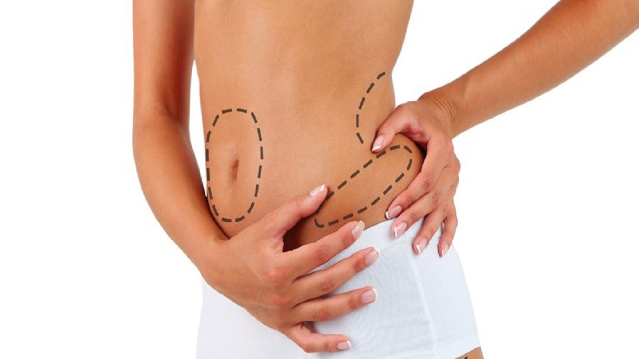 Liposuction Nedir ve İşlemi Nasıl Gerçekleşir?
