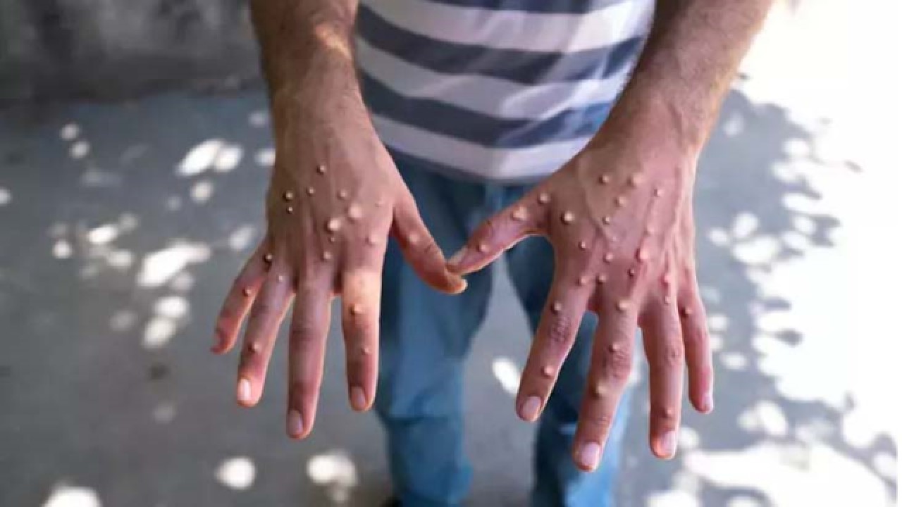 Maymun Çiçeği virüsü bir ülkede daha ortaya çıktı!