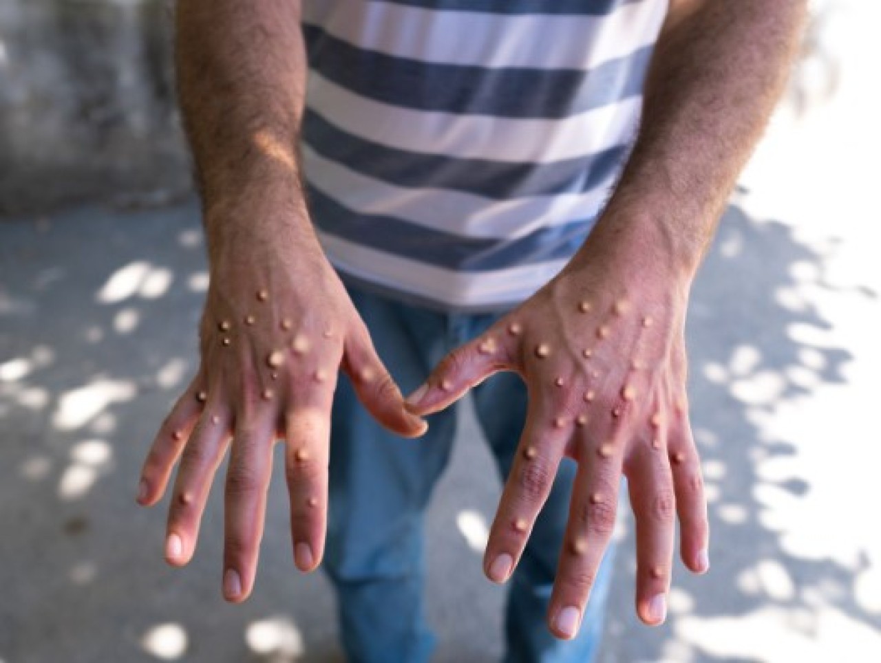 Maymun çiçeği virüsü bir ülkeye daha sıçradı!