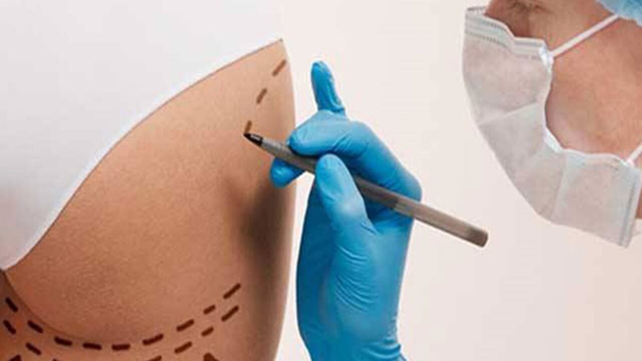 Kum Saati Vücut İçin Ameliyatsız Popo Dolgusu