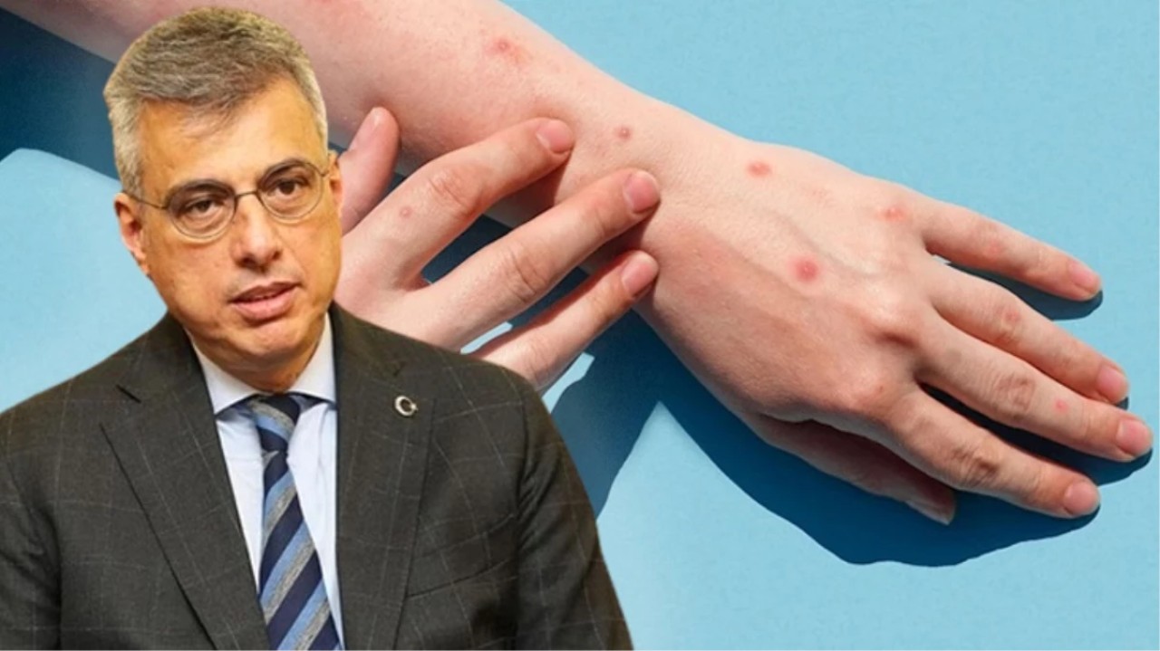 Maymun çiçeği virüsü Türkiye'ye geldi mi? Sağlık Bakanlığı'ndan flaş açıklama!