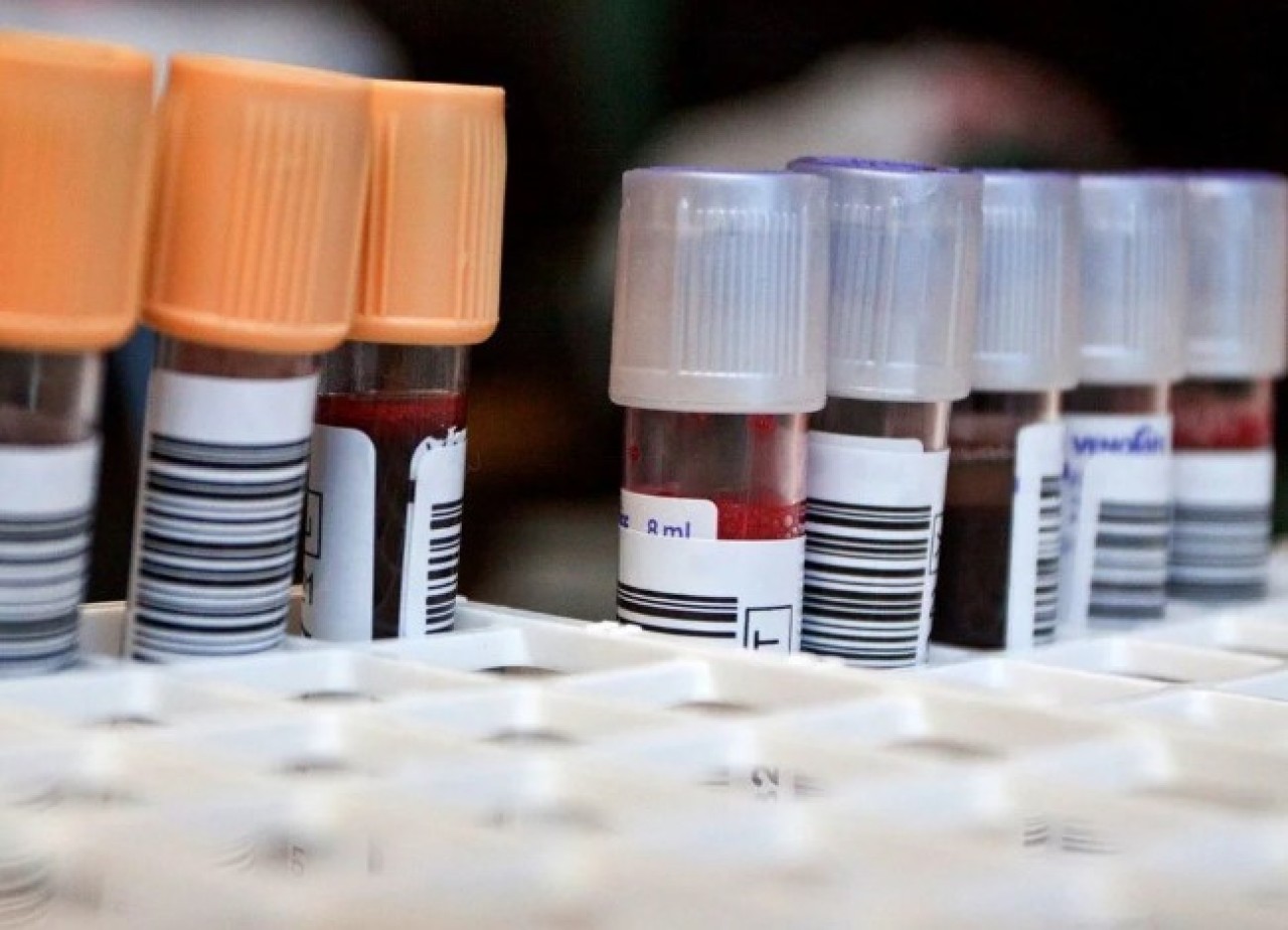 Bu kan grubuna sahip olanları bekleyen tehlike: Bunama riski daha fazla!