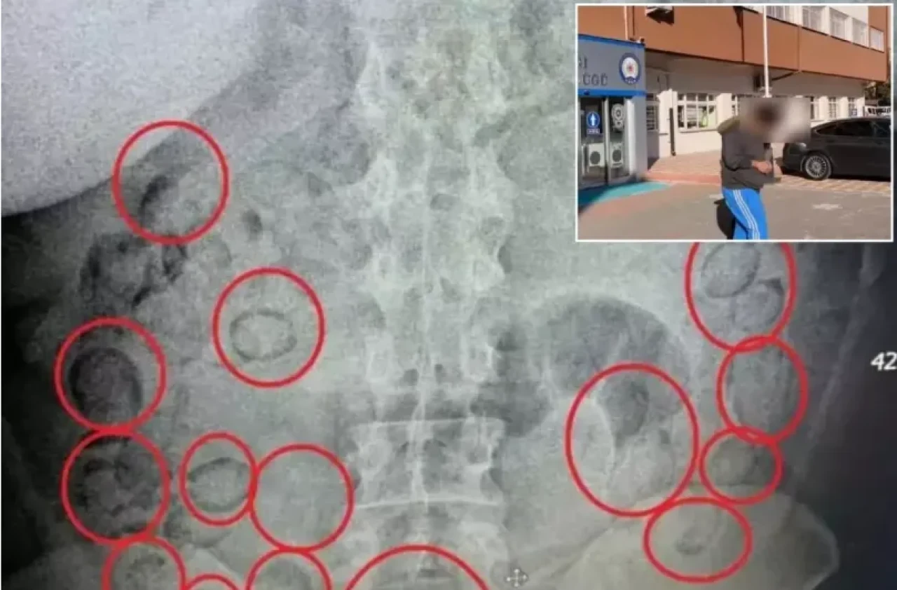 Aksaray'da pes dedirten olay! Midesinden 433 gram metamfetamin çıktı