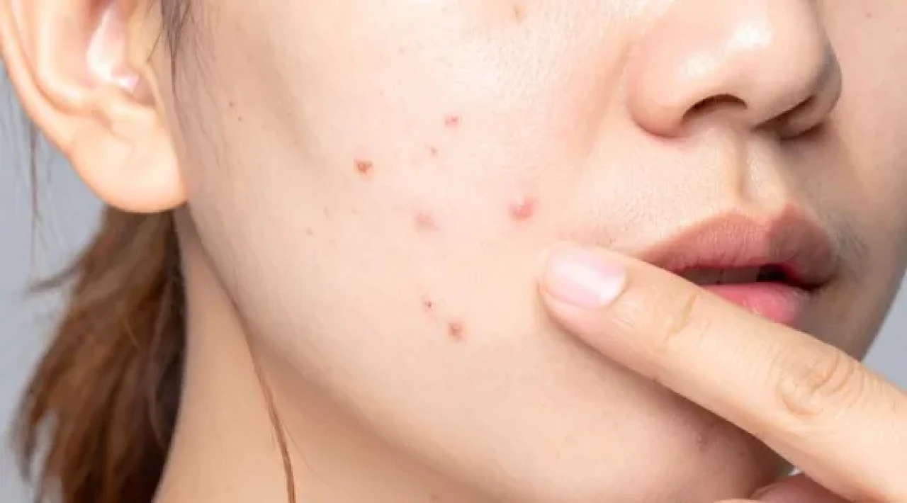 Cilt Lekelerini Gidermede En Etkili Tedavi Yöntemleri