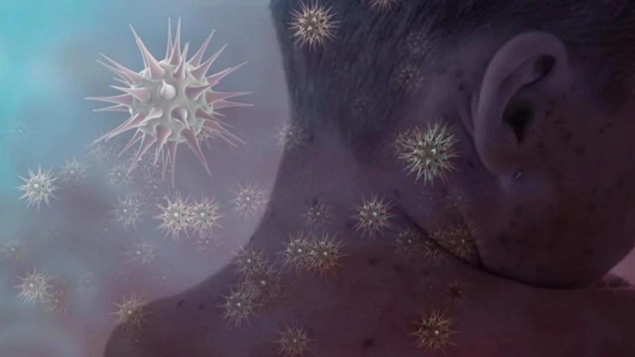 Kızamık vakası can aldı! 17 Kişi hayatını kaybetti...