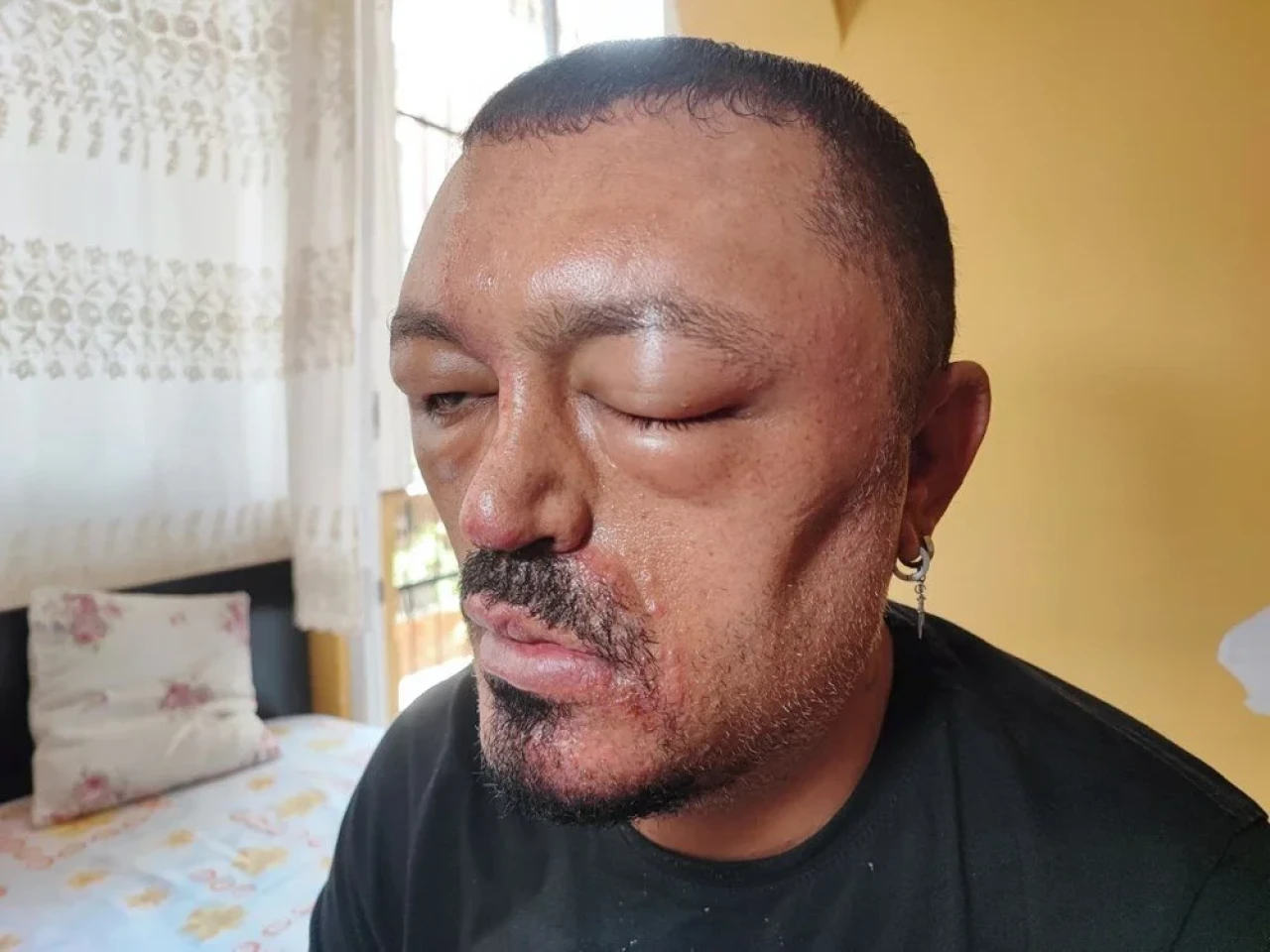 İnternetten aldığı siyahlaştırıcı şampuan kör ediyordu!