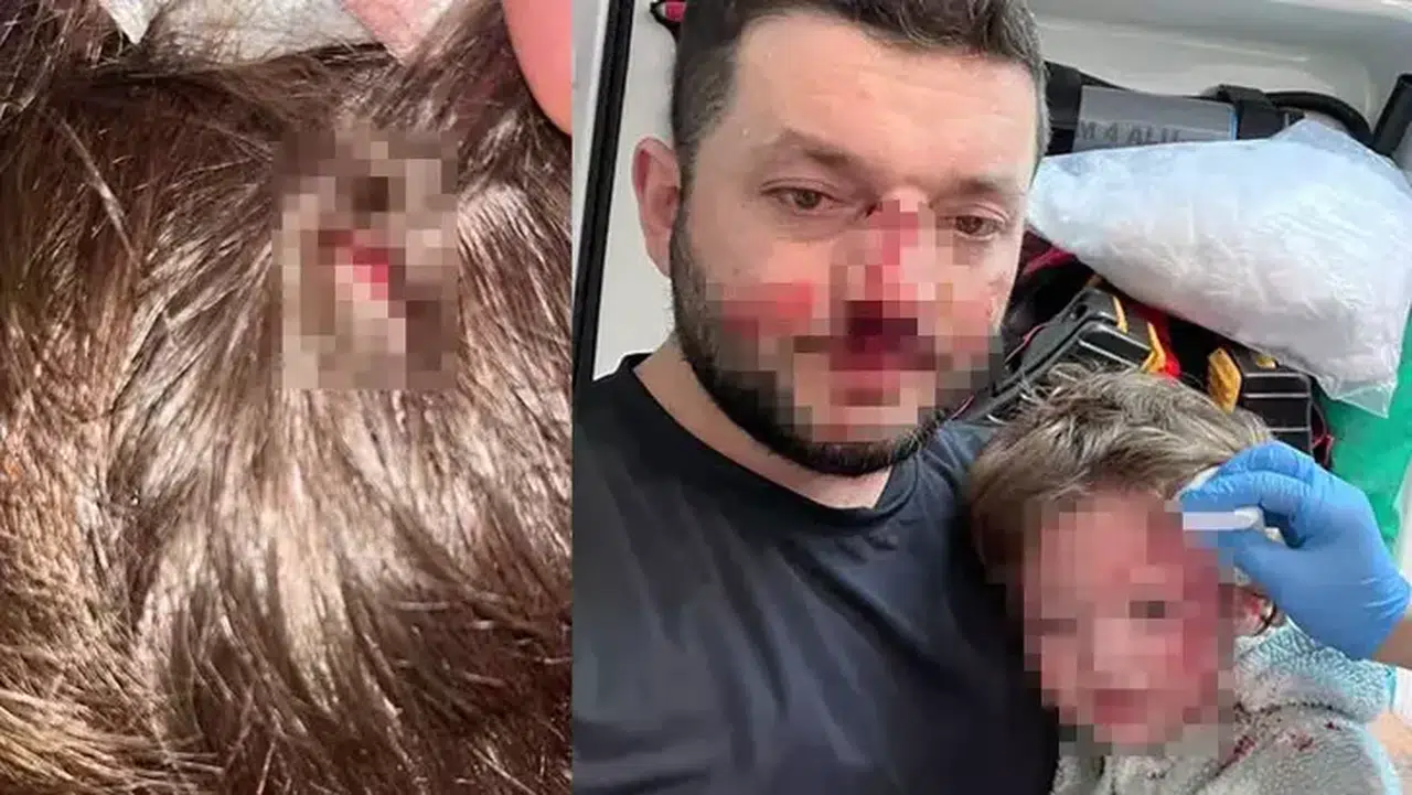 Kucağında bebeği ile darbedilmişti: Sokakta başına atılan taşla yaralandı!