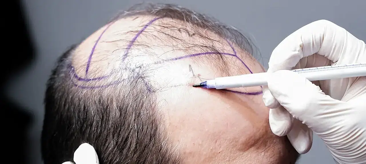 5000 Greft Saç Ekimi Fiyatı Ne Kadar? 2026 Güncel Maliyet Rehberi