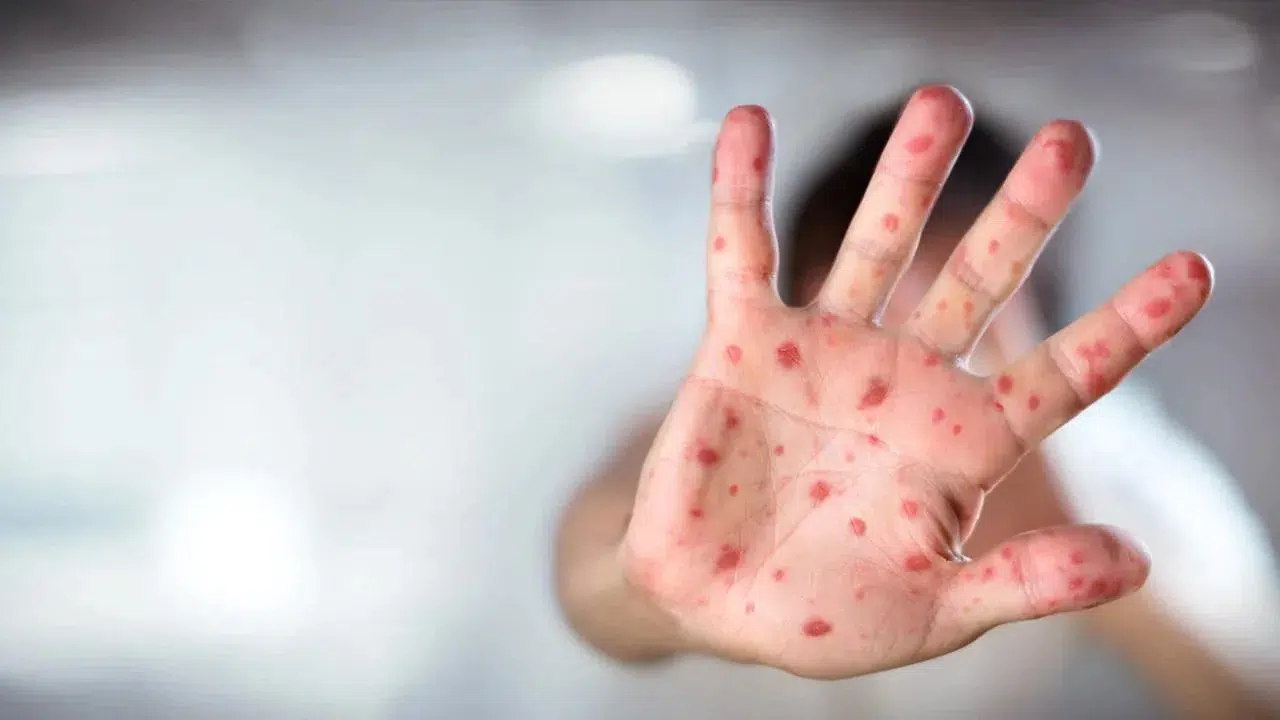 Bangladeş’te kızamık alarmı: 227 çocuk yaşamını yitirdi