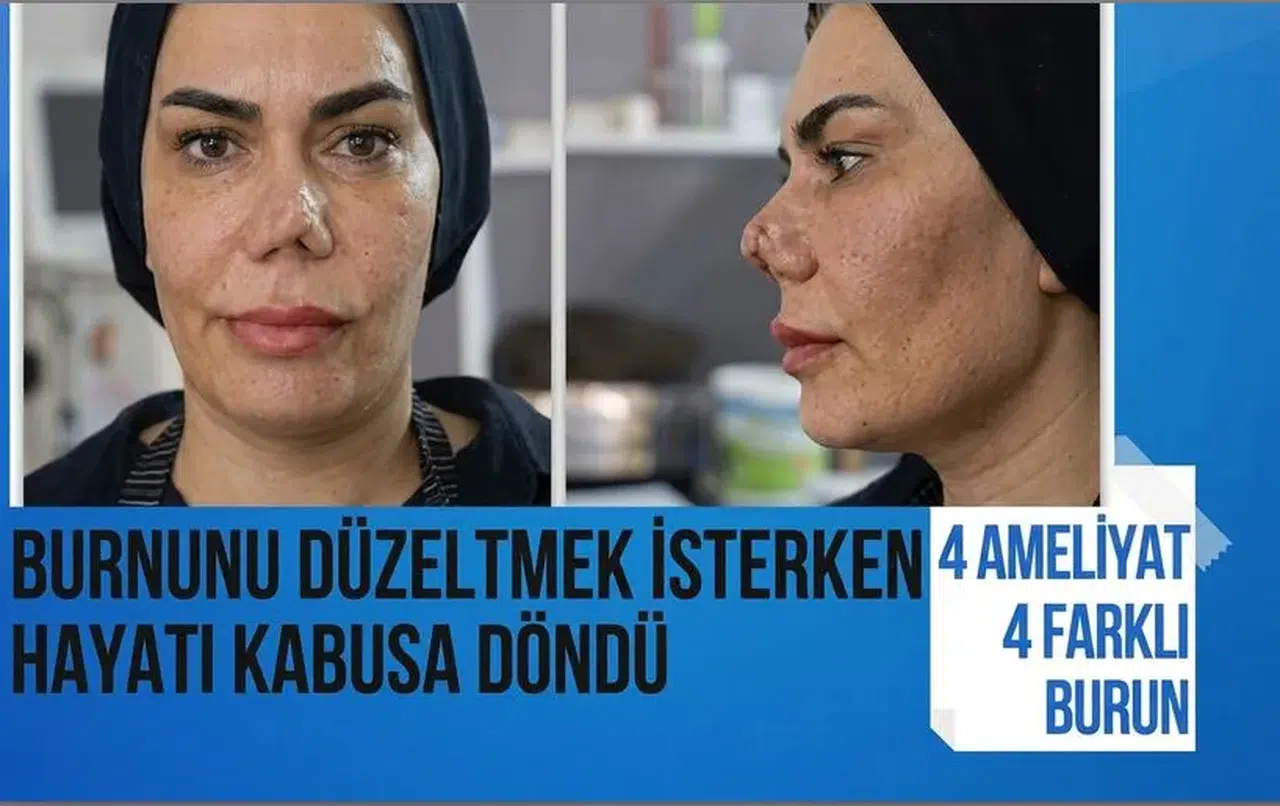 Burnunu düzeltmek isterken hayatı kabusa döndü: 4 ameliyat, 4 farklı burun
