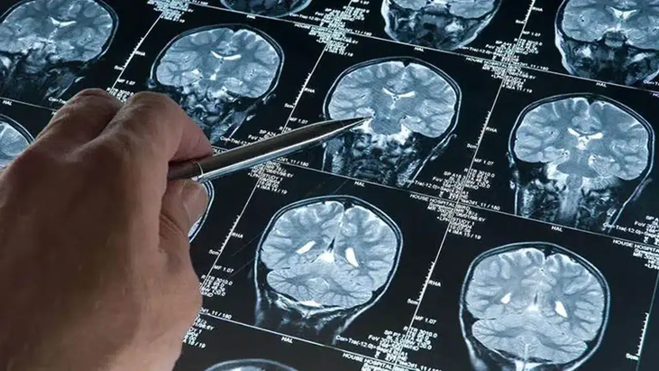 Uzmanlar açıkladı: Derin uyku Alzheimer'ın ilerlemesini yavaşlatabilir
