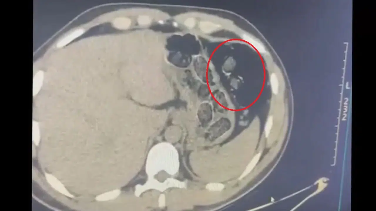 Midesinde uyuşturucuyla yakalanan 2 kişi tutuklandı