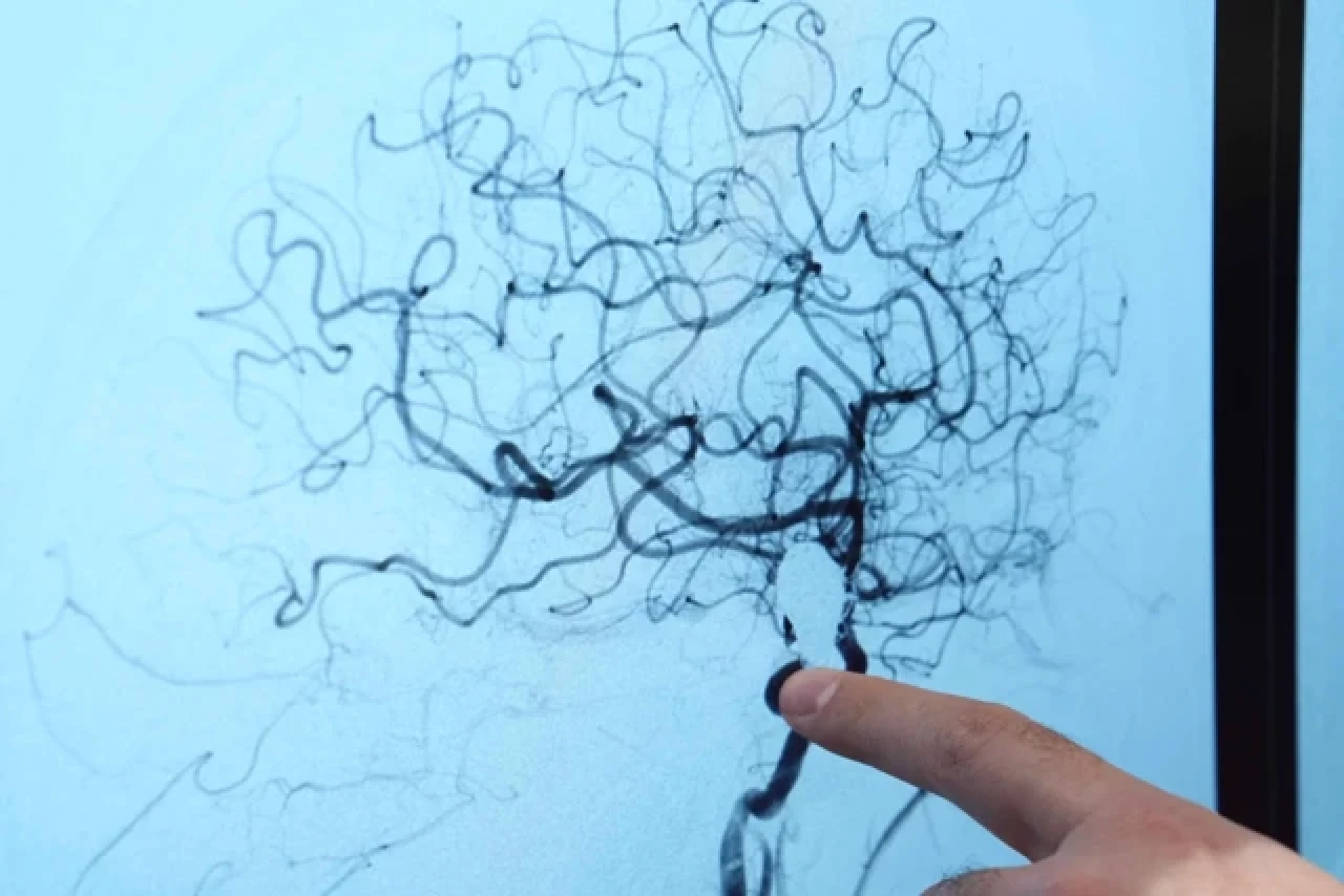 Beyin anevrizması her 20 kişiden birinde görülebilir