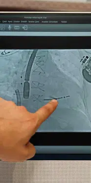70 gün yoğun bakımda kaldı, MitraClip yöntemiyle yeniden yürümeye başladı