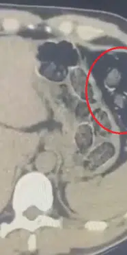 Midesinde uyuşturucuyla yakalanan 2 kişi tutuklandı
