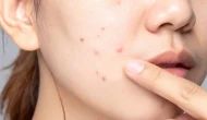 Cilt Lekelerini Gidermede En Etkili Tedavi Yöntemleri