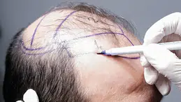 5000 Greft Saç Ekimi Fiyatı Ne Kadar? 2026 Güncel Maliyet Rehberi