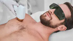 Erkekler İçin Lazer Epilasyon Rehberi
