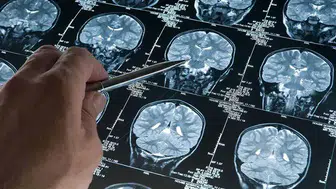 Uzmanlar açıkladı: Derin uyku Alzheimer'ın ilerlemesini yavaşlatabilir