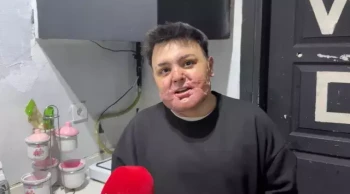 12 gün uyutuldu, 8 ayda 65 ameliyat geçirdi: 'Hiçbir engel beni yıldıramaz'