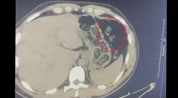 Midesinde uyuşturucuyla yakalanan 2 kişi tutuklandı