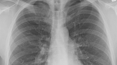 Pasif içicilerde "akciğer kanseri" riski yüzde 30 artıyor