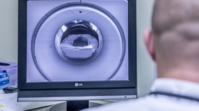 Bilim insanları yaygın görülen bir beyin tümörünün 3 alt türünü tespit etti