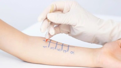 Alerji Testi Nasıl Yapılır?