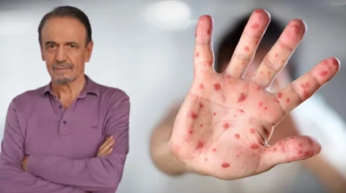 Dünyada maymun çiçeği alarmı! Mehmet Ceyhan'dan korkutan açıklamalar!