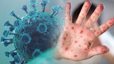 Sağlık Bakanlığı  maymun çiçeği virüsü için rehber yayımladı!