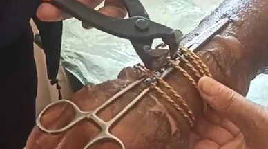 Kolu yanan kadının bilezikleri itfaiye tarafından kesilerek çıkarıldı