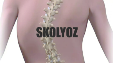 Skolyoz erken teşhis edilmezse tedavisi zorlaşabilir