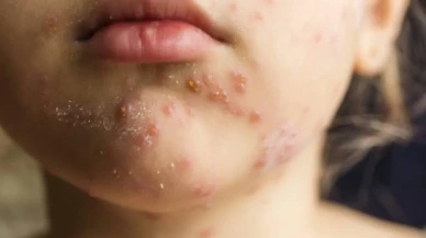 ABD'de kızamık alarmı, vakalar geçen yılın üç katını aştı