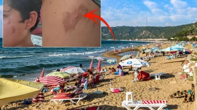 Vatandaşlar tedirgin! Denize giren yanıklarla çıkıyor