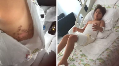 Gittikleri düğün felaketi oldu! Vücudunun yüzde 16'sı dondu