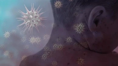 Kızamık vakası can aldı! 17 Kişi hayatını kaybetti...