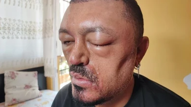 İnternetten aldığı siyahlaştırıcı şampuan kör ediyordu!