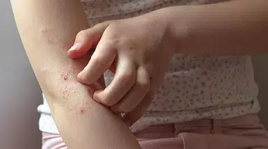 Uzmanlar uyardı: Baharda cilt sorunlarına dikkat